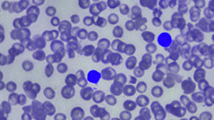 Figure from article: Chronic lymphocytic...
