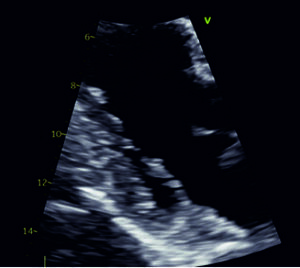 Figure from article: Mitral annular disjunction...