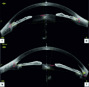 Figure from article: Familial angle-closure...