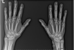 Figure from article: Overlap of rheumatoid...