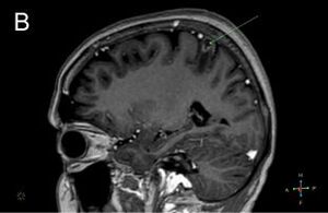 Figure from article: The listeriosis brain...