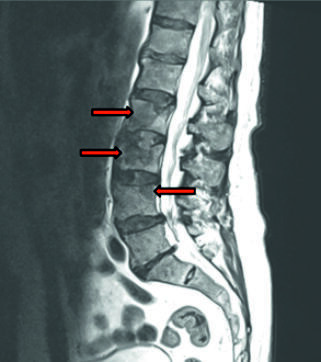 Figure from article: Transforaminal lumbar...