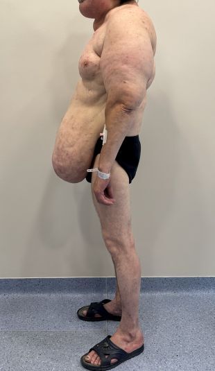 Figure from article: A rare case of Madelung...