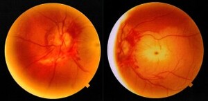 Figure from article: Choroidal rupture after...