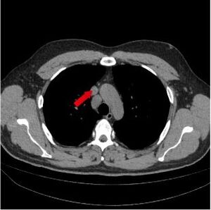 Figure from article: A case of sarcoidosis...