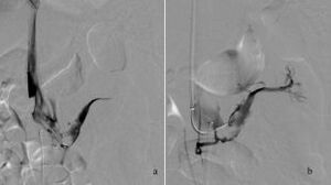 Figure from article: Thrombosis of the left...