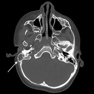 Figure from article: Masked mastoiditis...