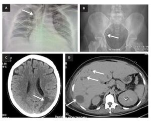 Figure from article: Myocarditis with multiorgan...